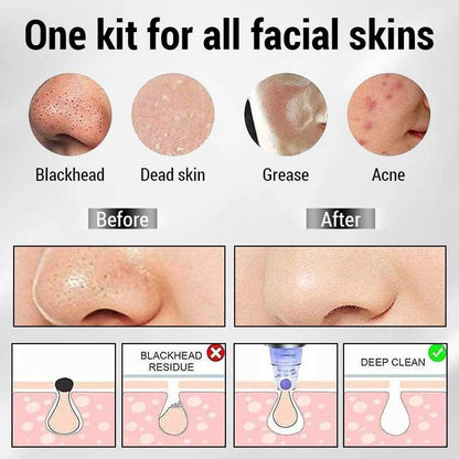 Electric Blackhead Remover — Deep Pore Vacuum Cleanser | Clearer, Smoother Skin